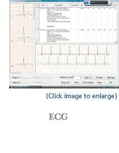 ecg